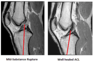 MRI revealing ACL healing